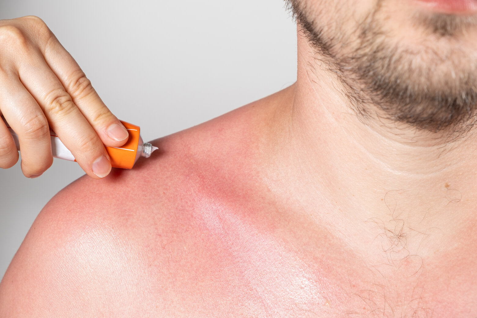 A close-up of a man with a sunburned shoulder and chest, applying soothing cream from a tube to relieve the irritation caused by the sunburn.