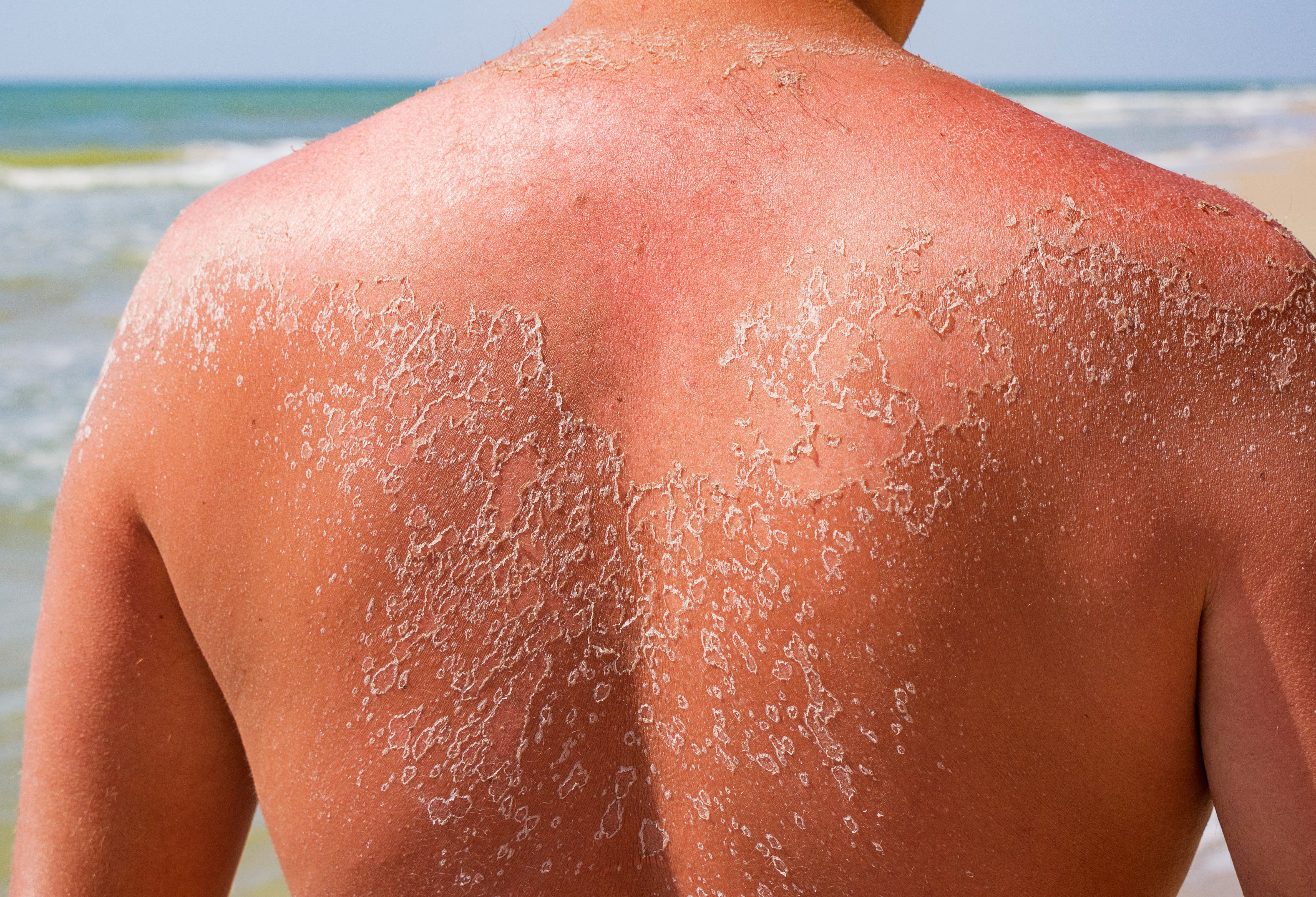 Close-up of a person's back with peeling, sunburned skin, showing significant sun damage. The skin is red and flaky, with large patches of peeling around the shoulders, indicating a severe sunburn. The person is standing near the ocean.