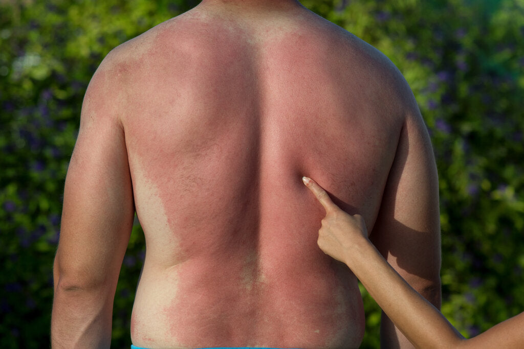 A person with a severe sunburn on their back, with another person pointing at the reddened skin. A visual reminder of the importance of sun protection to prevent UV damage.