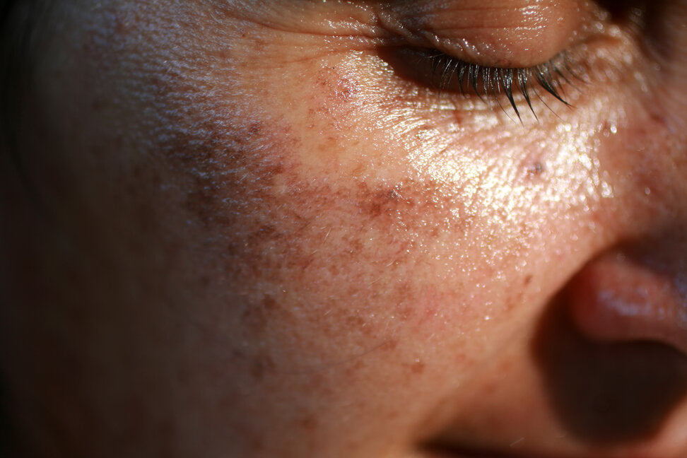 Close-up of a woman’s cheek showing visible sun damage, including pigmentation and uneven skin texture.