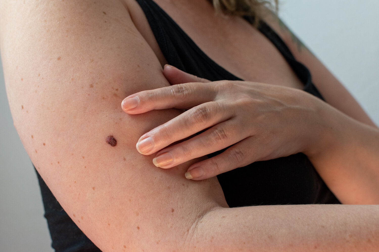 A close-up of a person examining a dark mole on their upper arm with their hand.