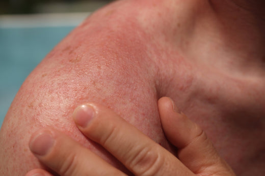 Close-up of a red, irritated shoulder with rough skin texture, indicating a possible sunburn or PMLE sun allergy reaction.