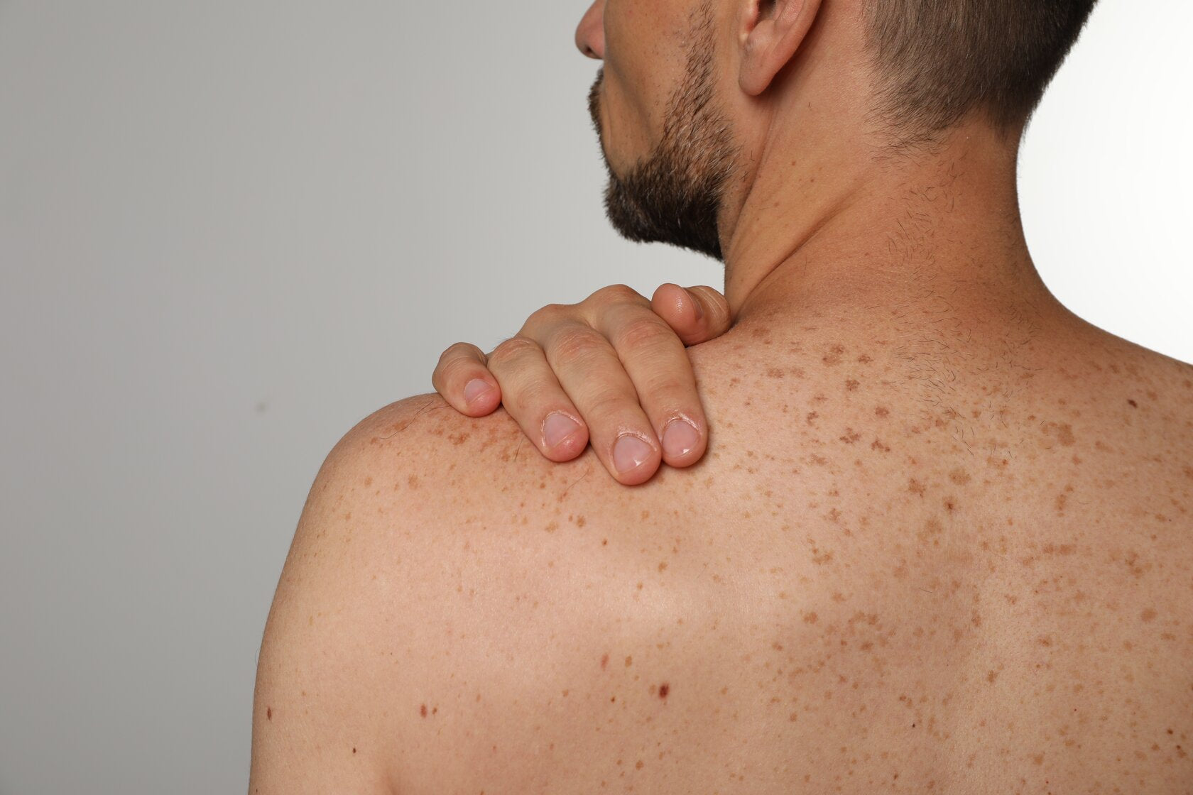 A close-up of a man's back showing numerous freckles and moles, with his hand resting on his shoulder. The image highlights the importance of skin checks and monitoring for potential skin cancer signs.