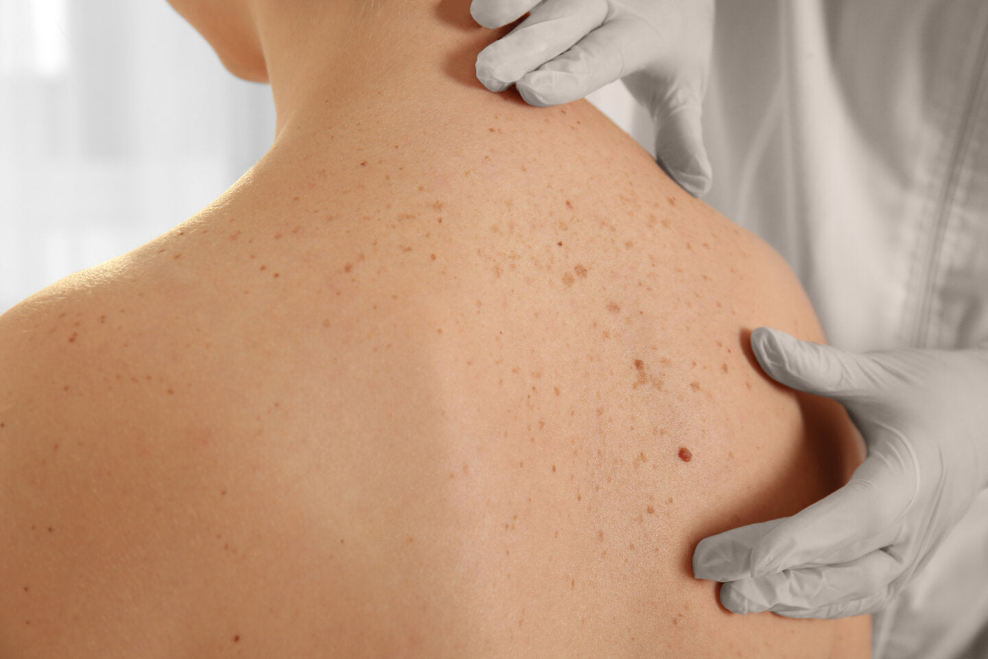 A dermatologist wearing gloves examining a patient's back for skin abnormalities and moles.