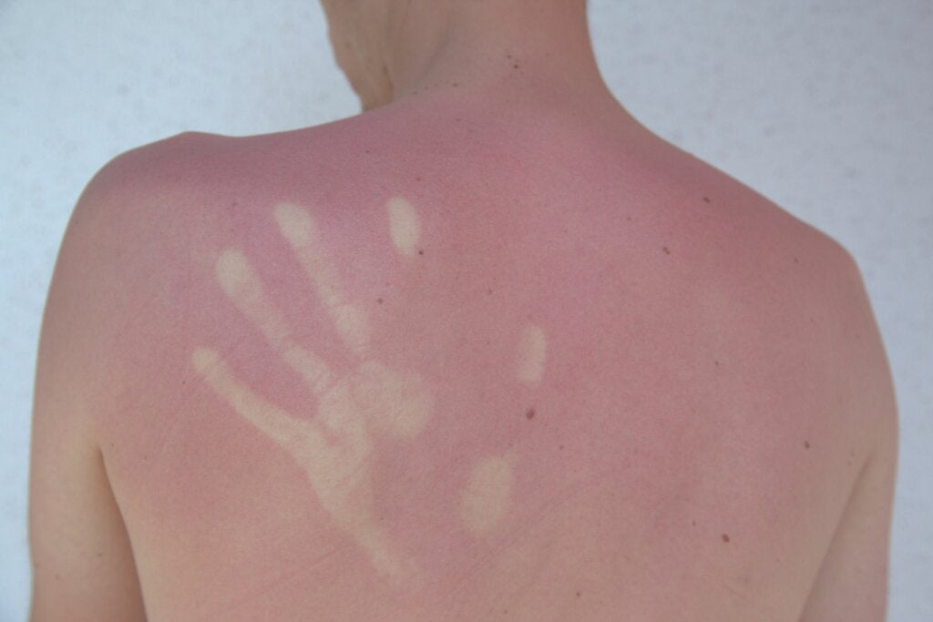 Back of a person with a visible sunburn showing a handprint outline, illustrating how RNA plays a role in the inflammatory response to UV damage and sunburn.