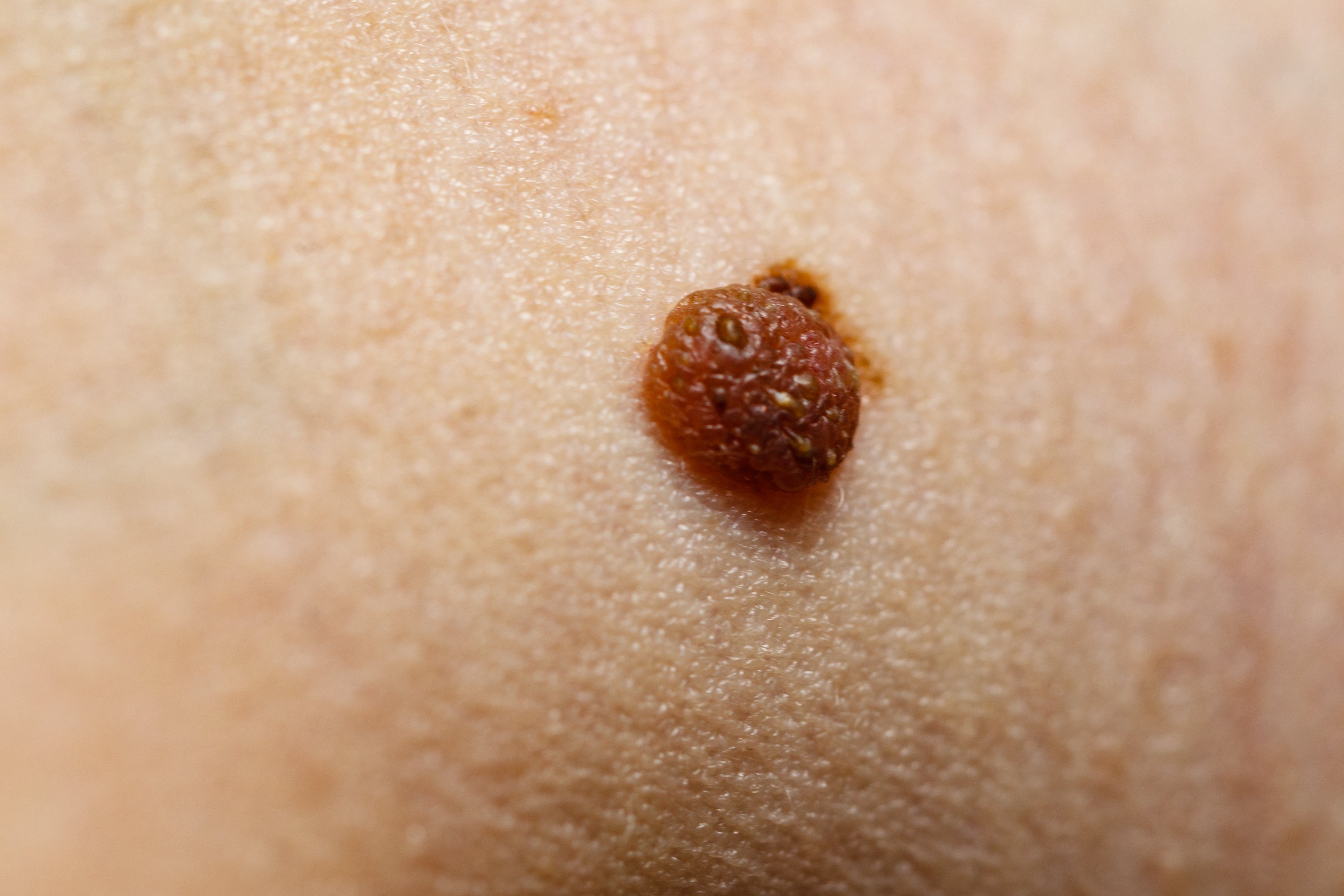 Close-up of a raised, irregularly shaped mole on human skin, showing distinct features that may indicate a potential skin issue, such as melanoma.