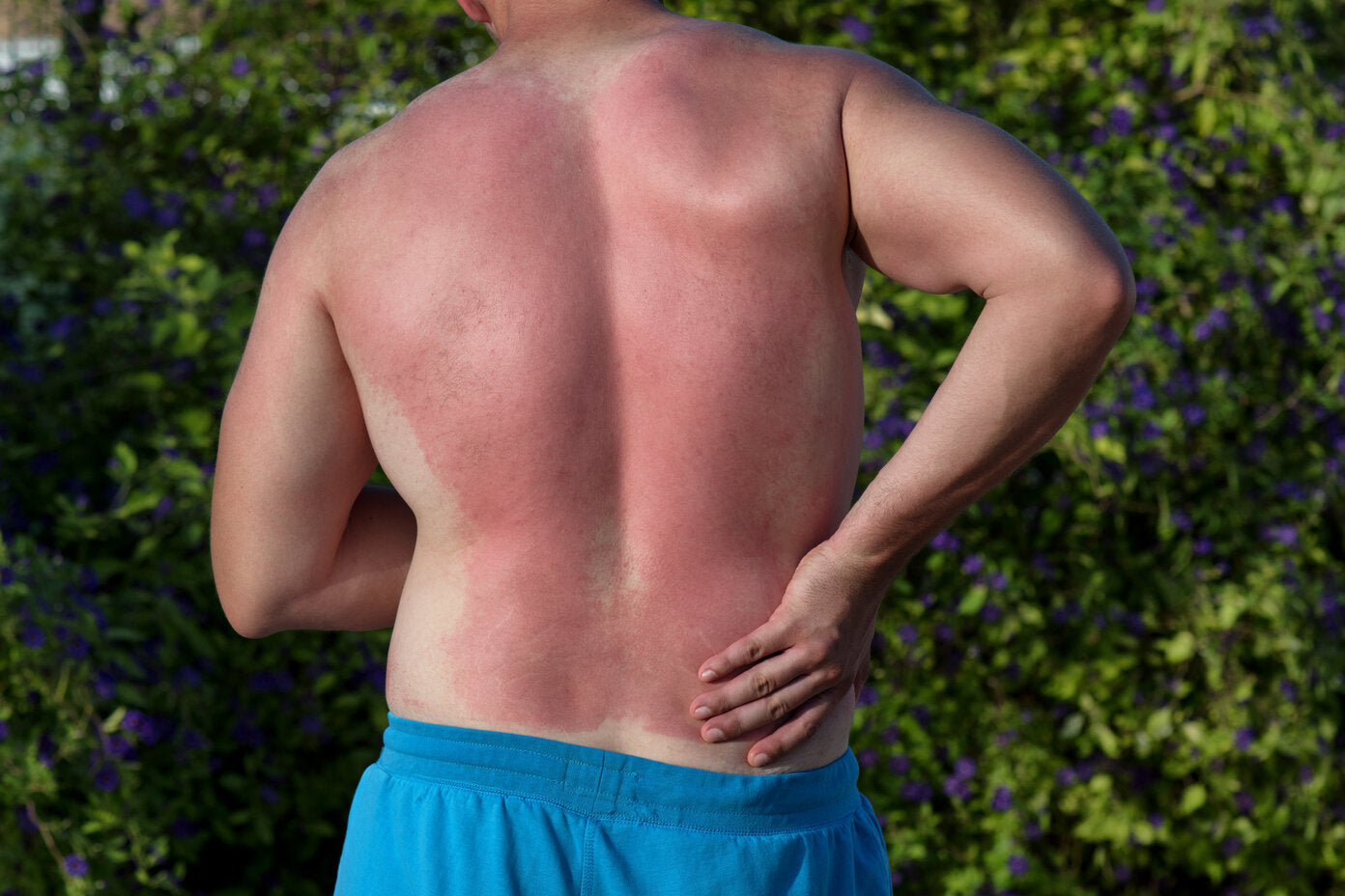 A man with a severe sunburn on his back, standing outdoors in blue shorts with one hand on his lower back, highlighting the sunburn's discomfort.