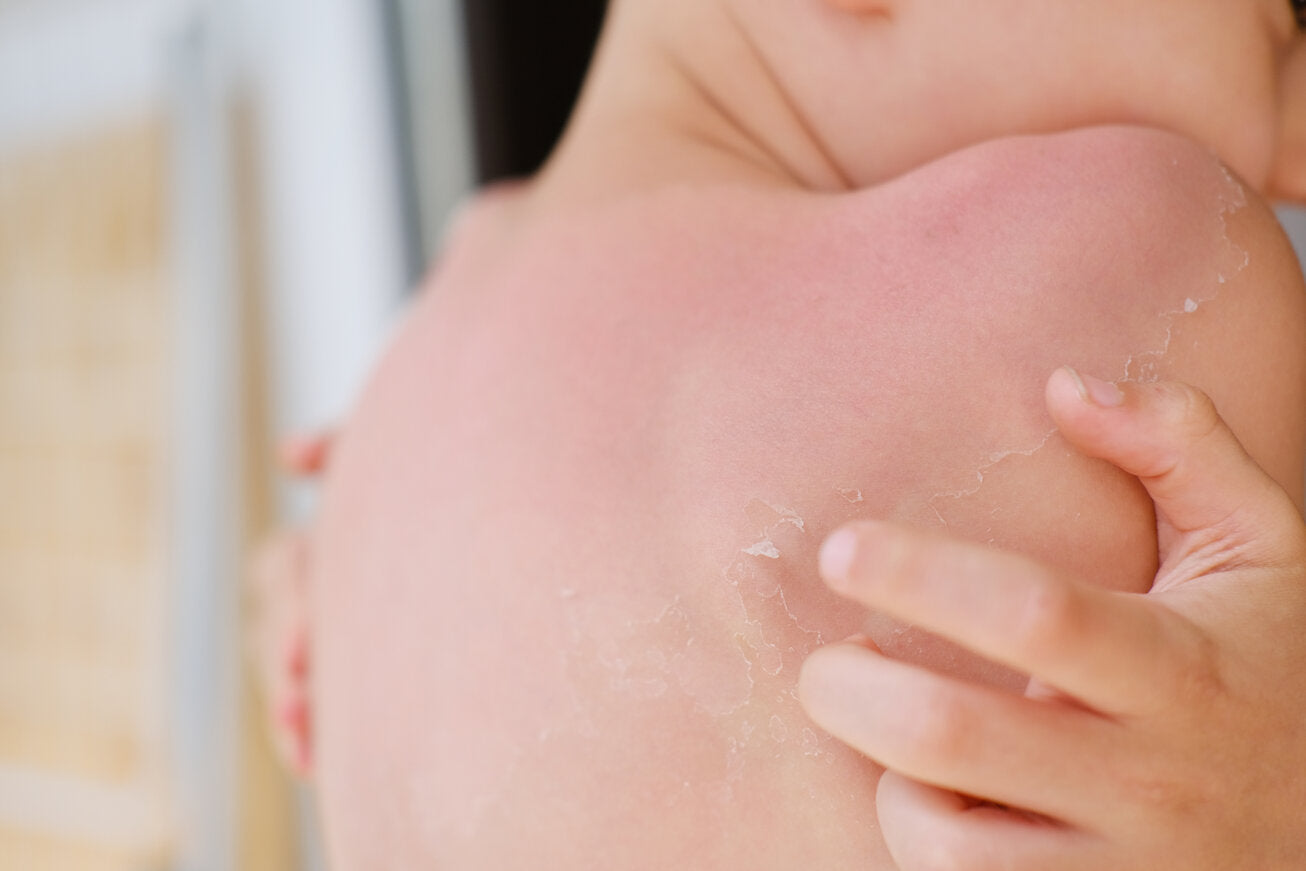 Close-up of peeling skin on a child's sunburned back and shoulders after sun exposure