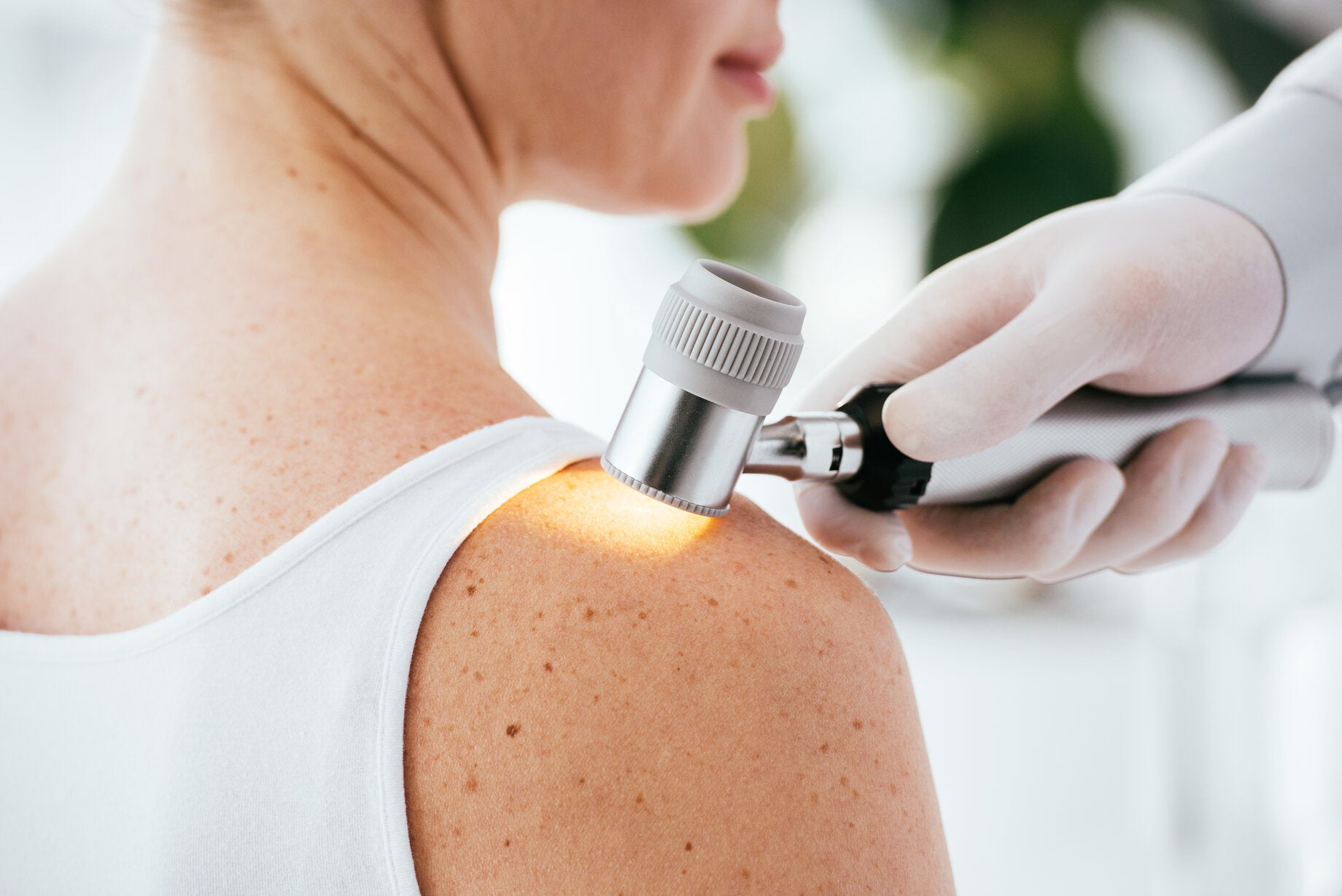 Dermatologist examining a woman's skin with a dermatoscope to check for sun damage or skin conditions